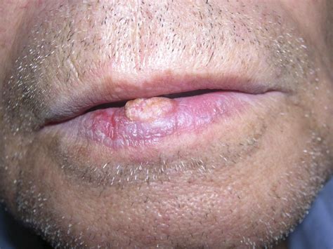 Squamous Cell Carcinoma of the Lower Lip - Journal of Oral and ...
