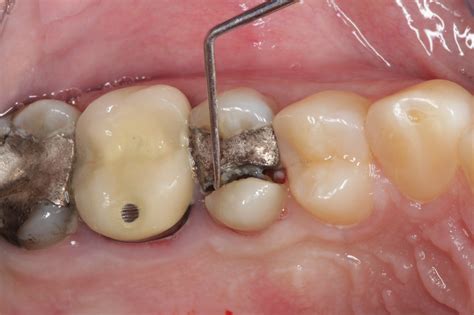 The problem with large metal (amalgam) fillings — Nova Smiles