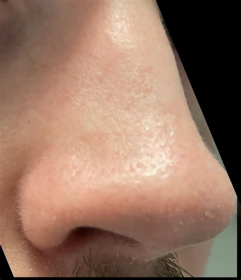 Difference in sebaceous filaments on nose week 1 and week 3 on 20 mg/day : Accutane