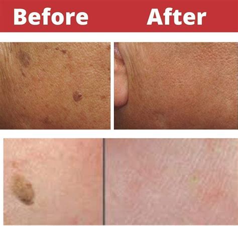 The Seborrheic Keratosis Removal Glycolic Acid Peel Solution The Specialised | Desertcart Kenya
