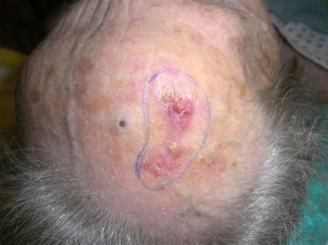 Basal-cell carcinoma of the head - DocCheck