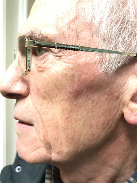 Skin Moles Removal Cost