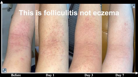 Understanding the Causes of Skin Folliculitis 毛囊炎 - TANGS CLINICAL TCM