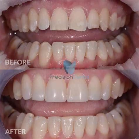 Dental Patients Smile Gallery | Before & After Smiles Via Digital Design