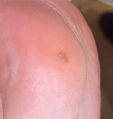 help with weird brown spot on foot under the skin : r/Melanoma