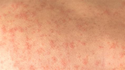 Rubeola Rash Treatment