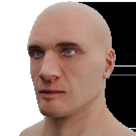 Infectious lesions of the external nose - causes, diagnosis and treatment