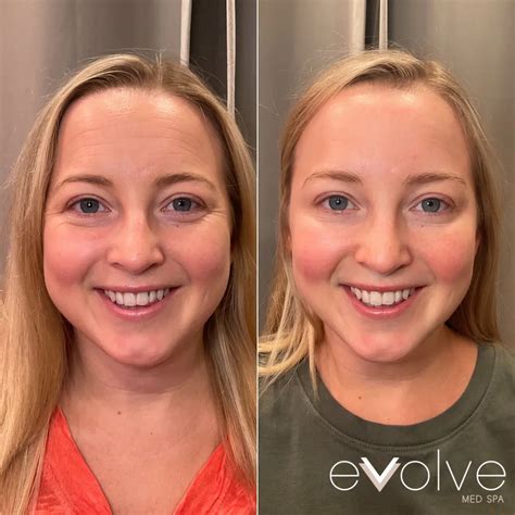 Botox for Crow's Feet | Before & After Photos