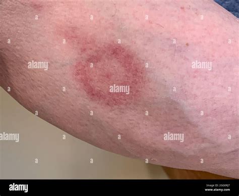 Bullseye Rash on Lower Leg, Sign of Lyme Disease. Nine days after bite. Color fading after five ...