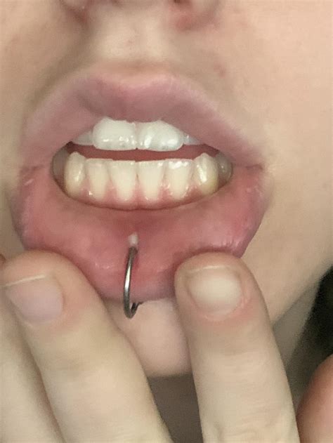 lip piercing is infected, need help! i got this done about 3 days ago ...