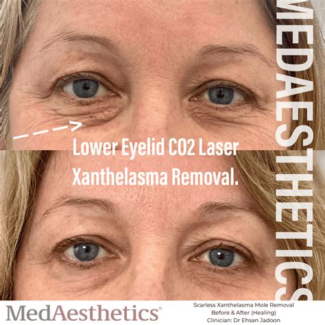 Laser Wart Removal Perth | MedAesthetics