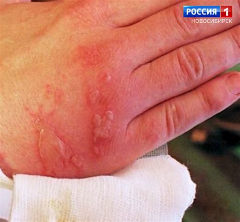 В Новосибирской области увеличилось число жертв опасной травы - Вести