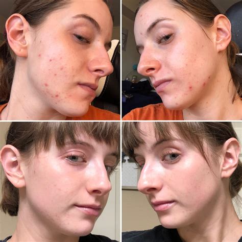 Ortho Tri Cyclen Lo Acne