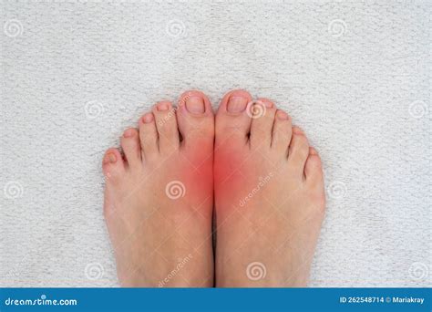 Feet Disease Rheumatism and Gout. Painful Gout Inflammation on Big Toe Joint with Red Spots ...