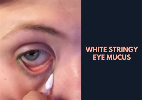 Can I Wear Contact Lenses If I Have Eye Mucus? | eyeSTYLE blog Lens.com