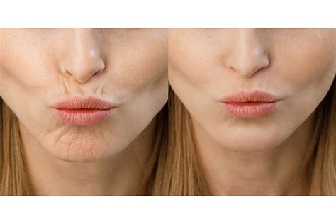 Кисетные морщины марионетки: как избавиться, убрать вокруг рта, над ...