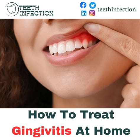 Gingivitis Quick Treatment at Wayne Enochs blog
