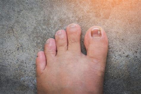 Big Toenail Bed Pain at Christopher Abbott blog