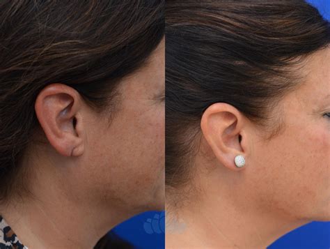 Earlobe Repair Before and After Pictures Case 88 | Charlotte, NC | Dilworth Facial Plastic Surgery