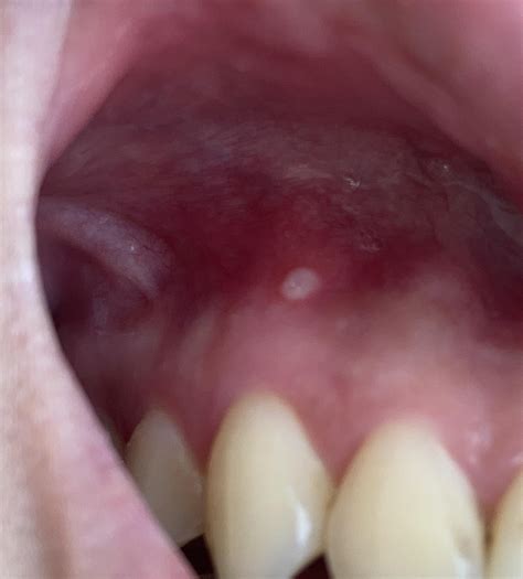 Flat pus-like pimple on gum above canine. Should I be concerned? : r/DentalHygiene