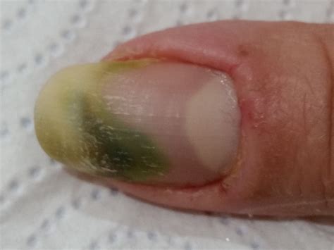 Why Is My Ingrown Fingernail Turning Green at Nathan Masterson blog