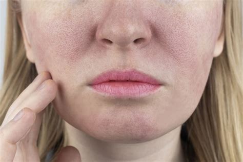 Red Blotchy Skin on Face: What It Is and How to Get Rid of It