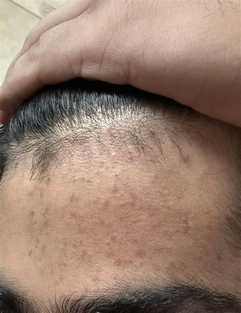 Hyperpigmentation Help : r/skincareaddictsindia