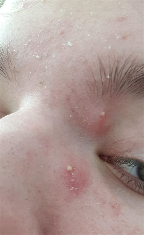 White Dots Under Eyes Not Milia / Eyelid Bumps 101 How To Identify Styes Milia Pimples Allure ...