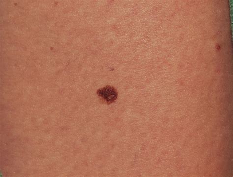 Nodular Melanoma Skin Cancer malignant melanoma - Skin Cancer Pictures - skinetix