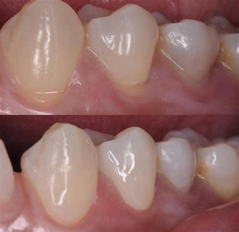Tooth Erosion At Gum Line at Katie Felton blog