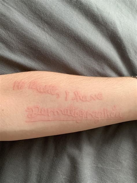 I have a rare skin condition allowing me to draw on my self (Dermatographia) : r/mildlyinteresting