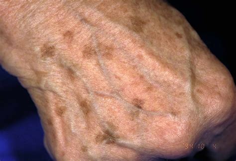 White Spots on Skin: Causes, Treatment, Prevention