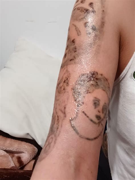 6 days after 8th session : r/TattooRemoval