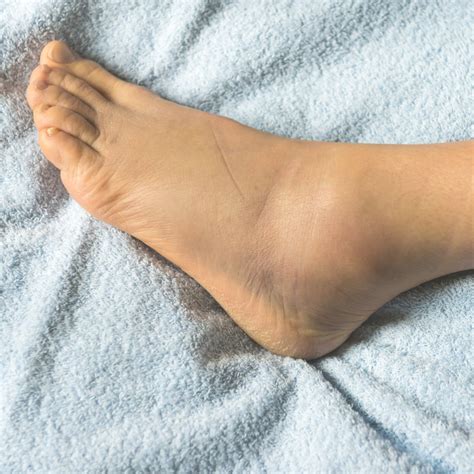 High Ankle Sprains: Symptoms, Diagnosis, and Treatment