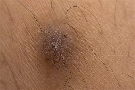 Everyone’s worst nightmare: Ingrown hairs in HEALTH AND SKINCARE ...