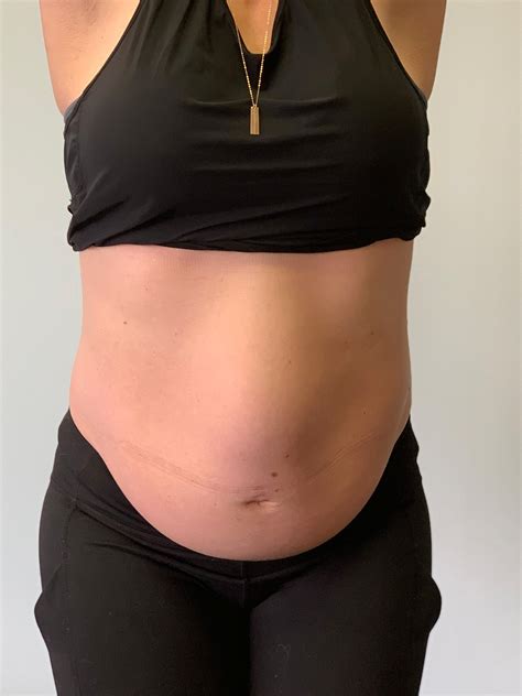 Diastasis Rectus Abdominis Cleveland OH — Cleveland Chiropractic ...