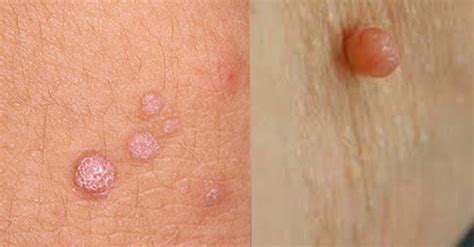 Skin Tag vs. Wart: Understanding the Difference – Skintify