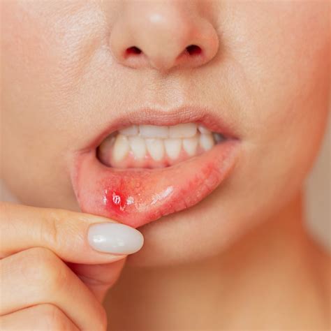 Mouth Sores Causes, Symptoms, and Effective Remedies