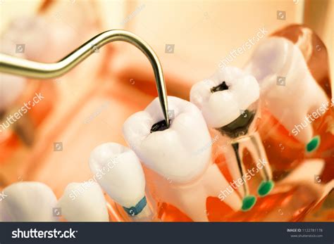 Remove Teeth Decay: Over 1,783 Royalty-Free Licensable Stock Photos | Shutterstock