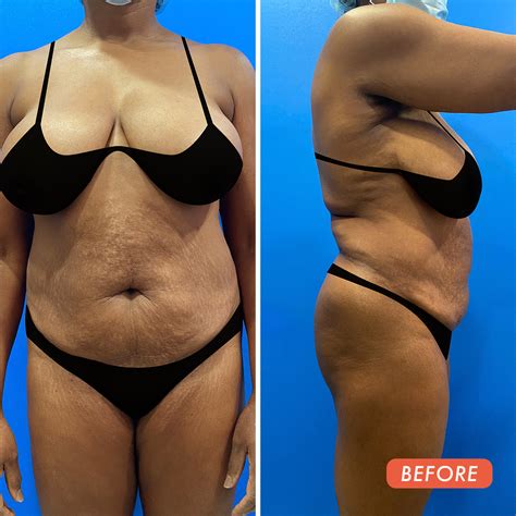 Before & After - Dr. William Miami