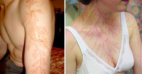 Lightning Strikes Human at Emily Jenkins blog