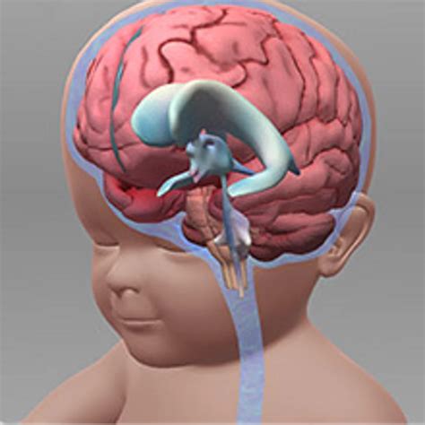 Hydrocephalus Behandling