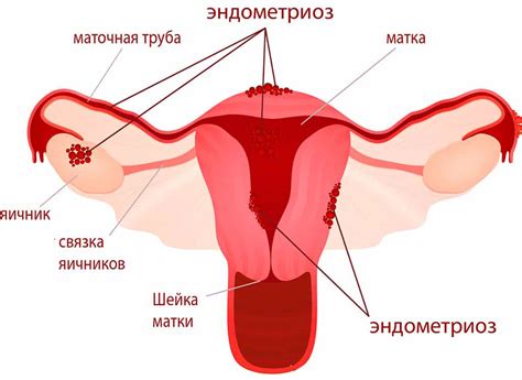 Эндометриоз - симптомы и лечение у женщин | Цена операции по удалению ...