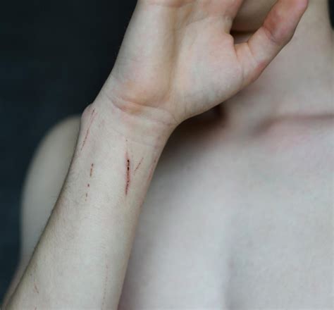 Self Harm Scars On Arm