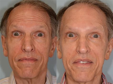 Endoscopic Brow Lift Results at Penny Troche blog