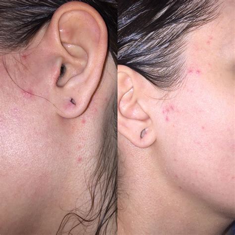 What Causes Acne In The Ear at Kathy Lighty blog
