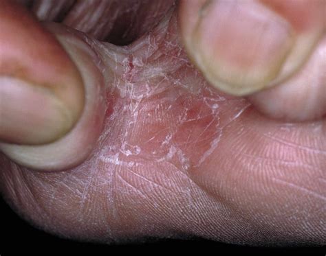Treatments and Remedies to Get Rid of Athlete's Foot