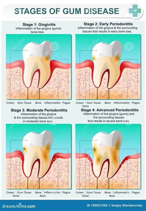 Gum Disease Stages