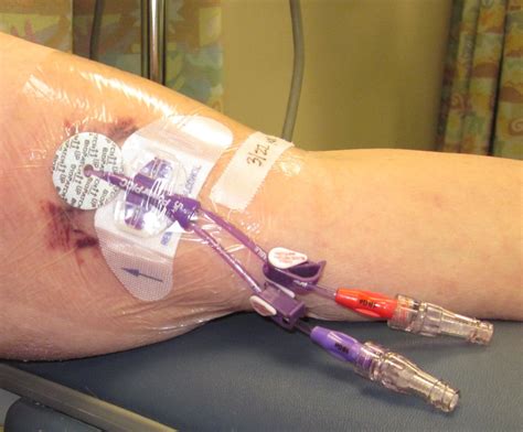 How To Perform A Picc Line Dressing Change at Kevin Broadway blog