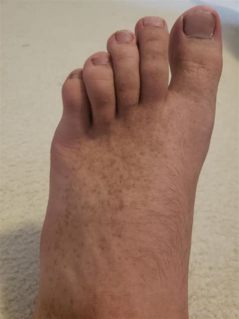 Small Brown Spots On Foot – Brown Spots On The Feet – HEQXD
